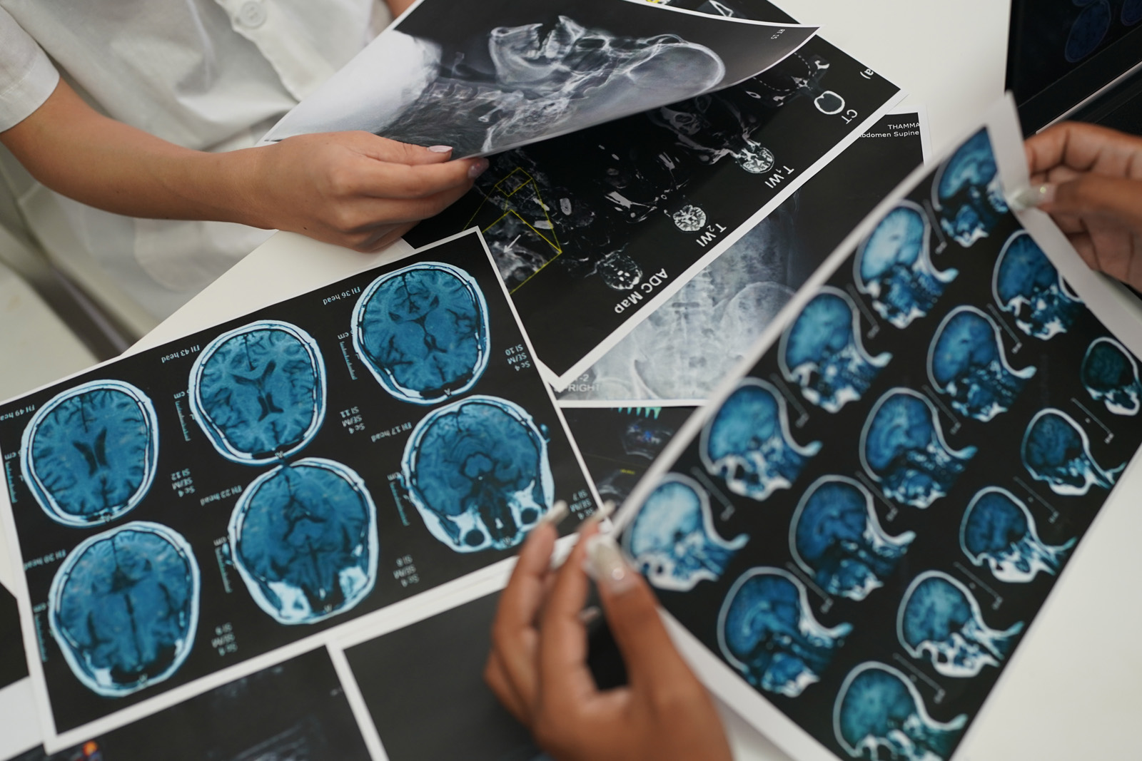 Farmaci per l’Alzheimer in sviluppo nel 2024: speranza all’orizzonte